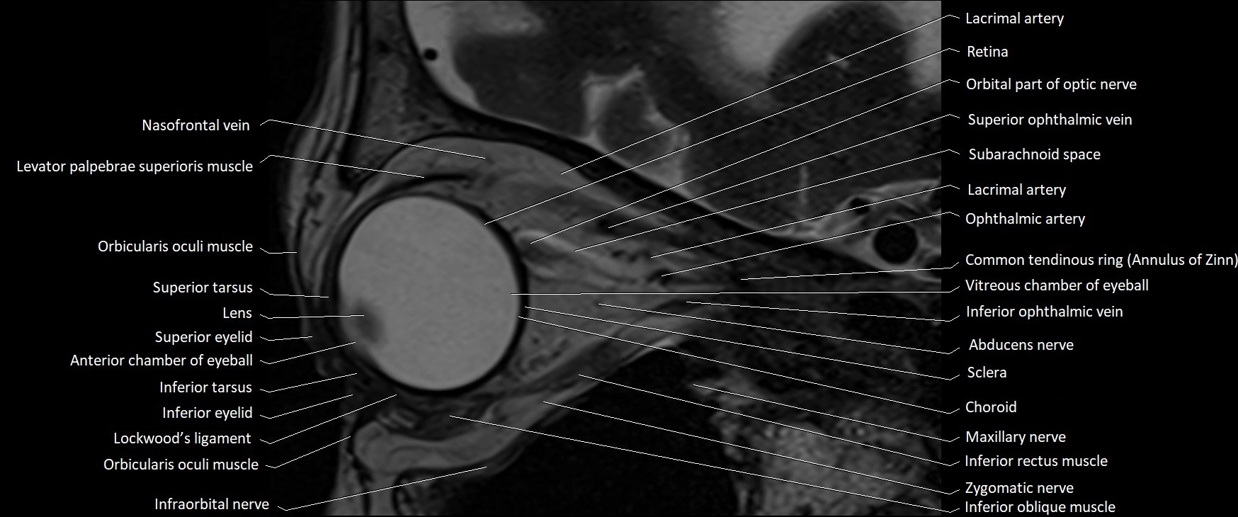 MRI Orbit sagittal cross sectional anatomy 3T image 11.webp
